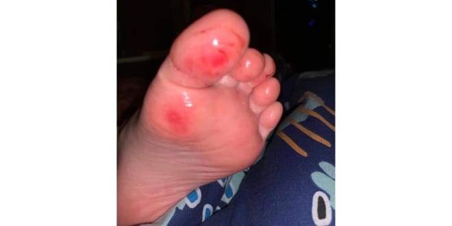 ‘Cuts and grazes’ at new Mirboo North pool